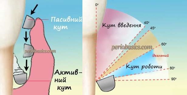 кюретаж