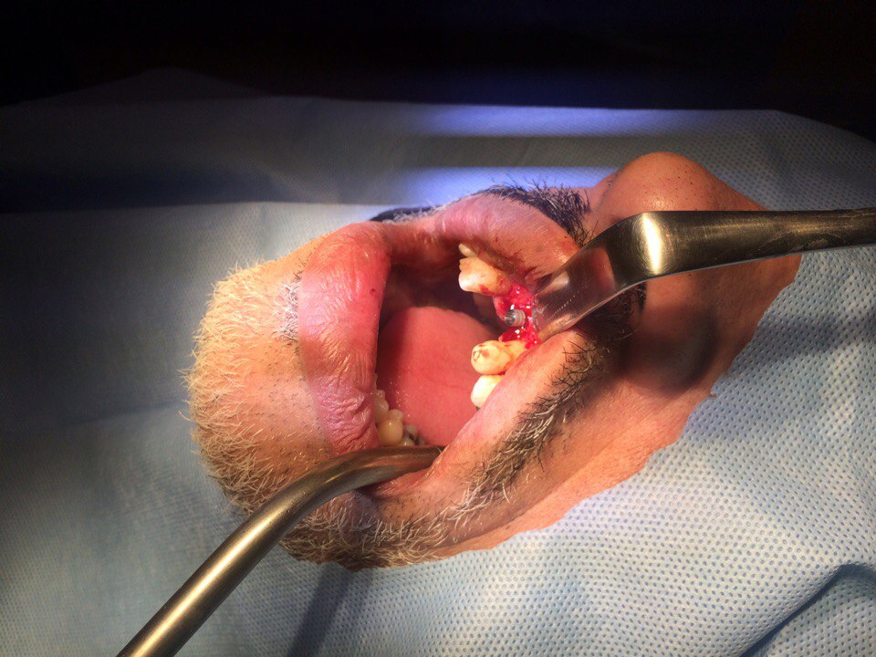 Implantswiss