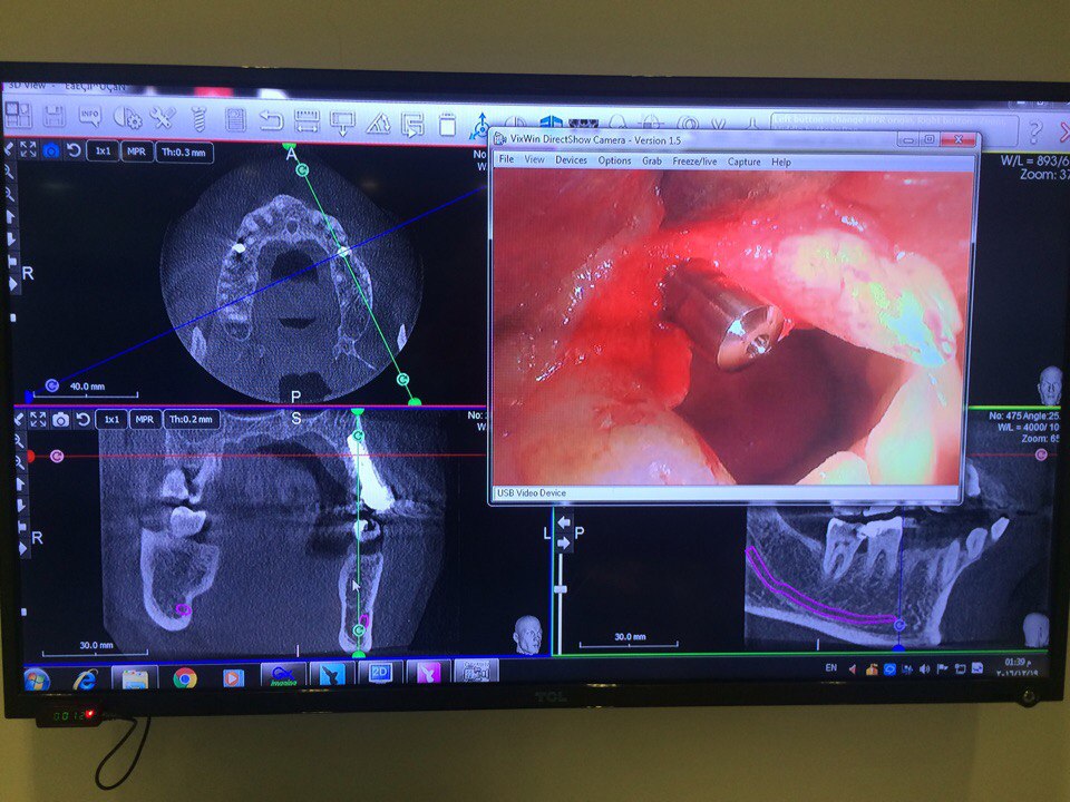 Implantswiss