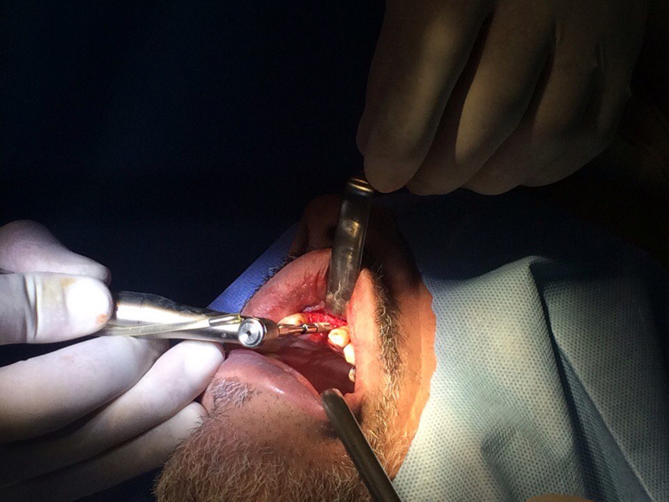 Implantswiss