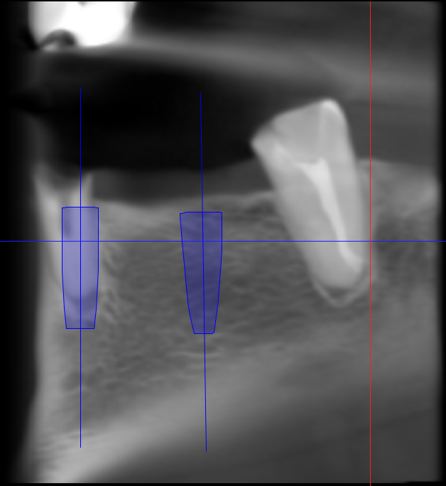 Імплантація імплантатів Implantswiss в ділянці 44, 46.