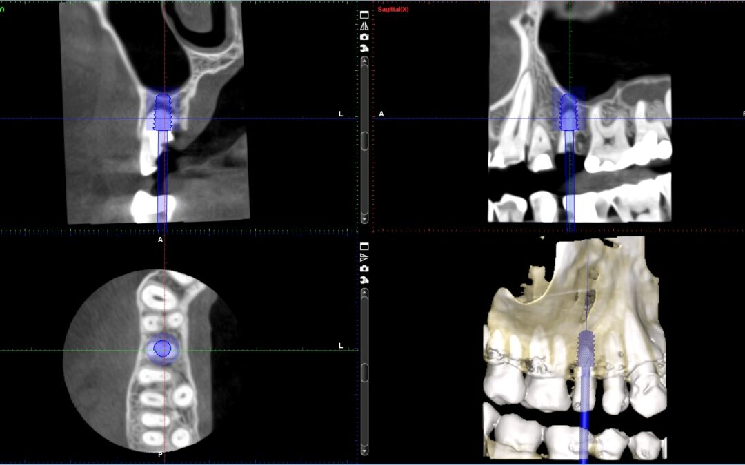 Одноетапне встановлення імплантату Implantswiss в ділянці 15 із використанням препарату бікальцій сульфату. Клінічний випадок.