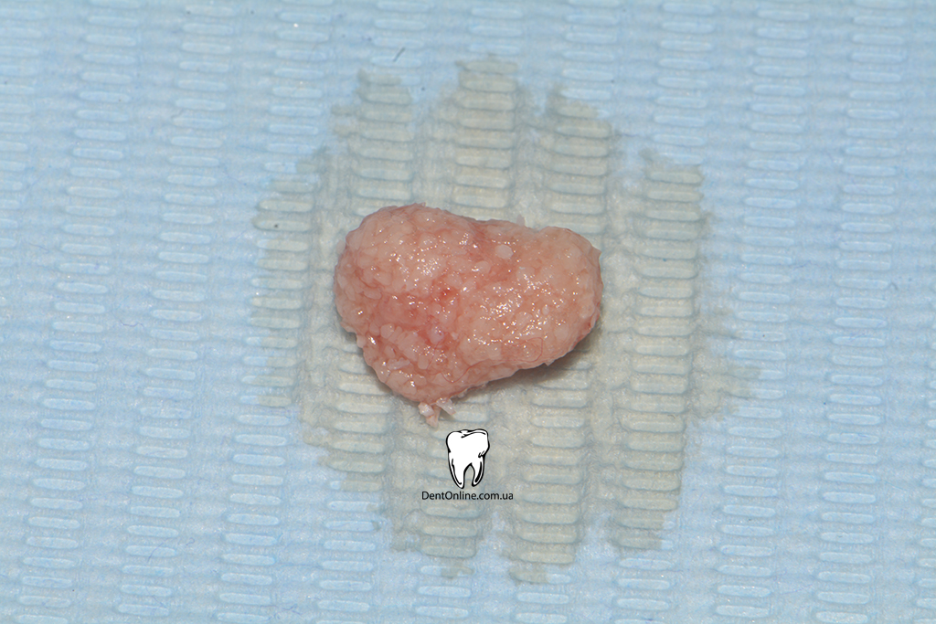 імплантація implantswiss