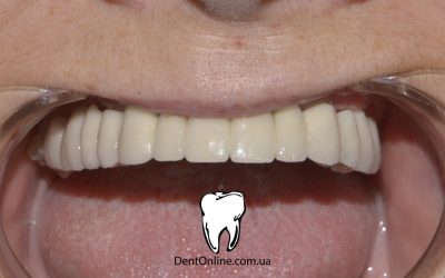 Тотальна реабілітація з використанням імплантатів Implantswiss: редукція альвеолярного відростка, все на 5 на верхній щелепі, збільшення міжальвеолярної висоти, металокерамічні коронки та металокерамічний мостоподібний протез на нижній щелепі