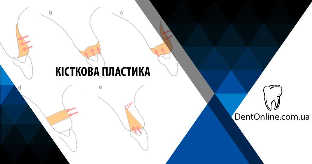 курс по імплантології кісткова пластика
