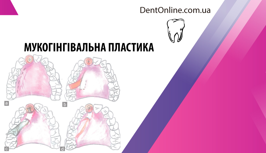 курс по імлантології мукогінгівальна пластика