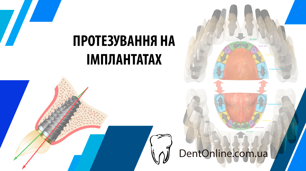 семінар протезування на імплантатах