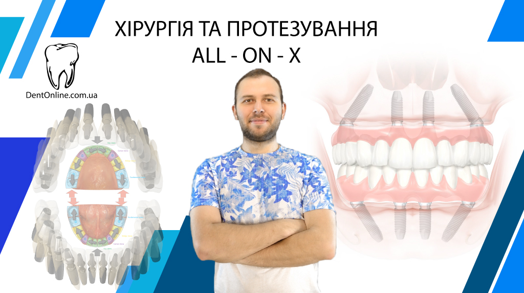 Хірургія та протезування ALL-ON-X